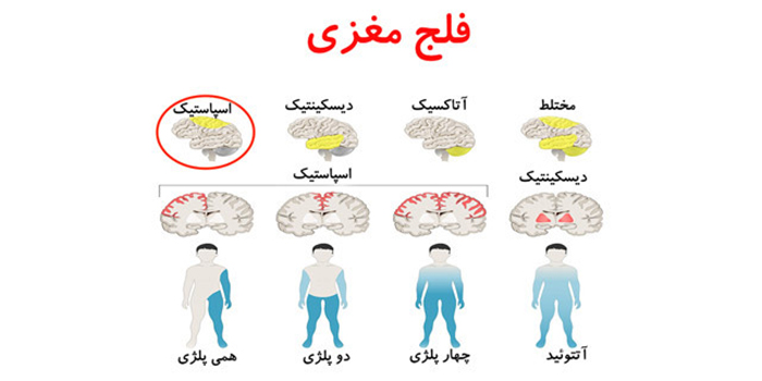 انواع فلج مغزی