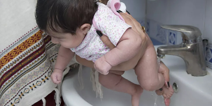 درمان سوختگی پای نوزاد